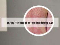 肛门为什么银屑病 肛门有银屑病擦什么药