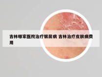 吉林哪家医院治疗银屑病 吉林治疗皮肤病费用