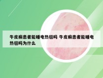 牛皮癣患者能睡电热毯吗 牛皮癣患者能睡电热毯吗为什么