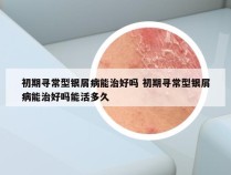 初期寻常型银屑病能治好吗 初期寻常型银屑病能治好吗能活多久