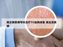 商丘银屑病专科治疗TO选杨淑莲 商丘皮肤病