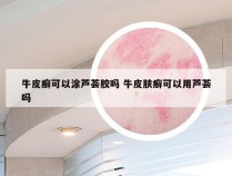 牛皮癣可以涂芦荟胶吗 牛皮肤癣可以用芦荟吗