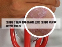 沈阳哪个医院看牛皮癣最正规 沈阳看银屑病最权威的医院