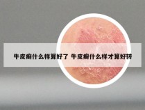 牛皮癣什么样算好了 牛皮癣什么样才算好转
