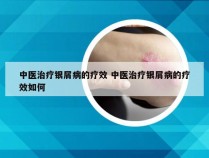 中医治疗银屑病的疗效 中医治疗银屑病的疗效如何
