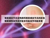 银屑病关节炎会残疾吗银屑病关节炎的影响 银屑病性关节炎可能会引起关节功能损害