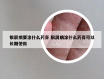 银屑病要涂什么药膏 银屑病涂什么药膏可以长期使用