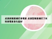 点滴状银屑病打青霉素 点滴型银屑病打了长效青霉素多久能好