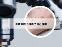 牛皮癣晚上睡着了自己挠破