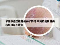 掌跖脓疱型银屑病会扩散吗 掌跖脓疱银屑病脓疱可以扎破吗