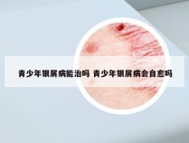 青少年银屑病能治吗 青少年银屑病会自愈吗