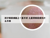 孩子银屑病腿上一直不好 儿童得银屑病为什么不痒