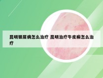 昆明银屑病怎么治疗 昆明治疗牛皮癣怎么治疗