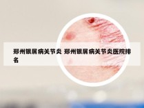 郑州银屑病关节炎 郑州银屑病关节炎医院排名