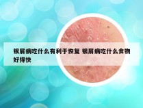银屑病吃什么有利于恢复 银屑病吃什么食物好得快