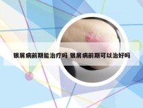银屑病前期能治疗吗 银屑病前期可以治好吗