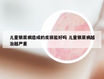 儿童银屑病造成的皮损能好吗 儿童银屑病越治越严重
