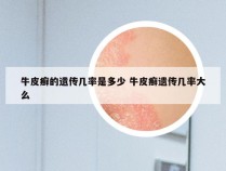 牛皮癣的遗传几率是多少 牛皮癣遗传几率大么