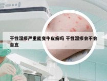 干性湿疹严重能变牛皮癣吗 干性湿疹会不会自愈