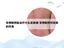 生物制剂能治疗什么皮肤病 生物制剂对皮肤的作用