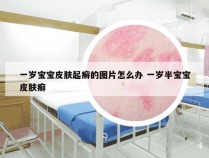 一岁宝宝皮肤起癣的图片怎么办 一岁半宝宝皮肤癣