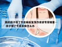 我的孩子得了牛皮癣反复发作求求专家哪里… 孩子得了牛皮皮癣怎么办