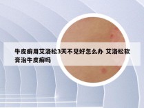 牛皮癣用艾洛松3天不见好怎么办 艾洛松软膏治牛皮癣吗
