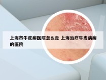 上海市牛皮癣医院怎么走 上海治疗牛皮病癣的医院