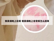 银屑病晚上巨痒 银屑病晚上非常痒怎么回事