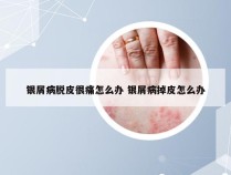 银屑病脱皮很痛怎么办 银屑病掉皮怎么办