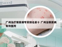 广州治疗银屑病专家排名前十 广州治银屑病有效医院