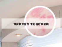 银屑病生化剂 生化治疗银屑病