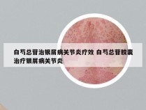 白芍总苷治银屑病关节炎疗效 白芍总苷胶囊治疗银屑病关节炎