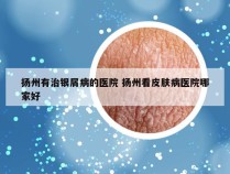扬州有治银屑病的医院 扬州看皮肤病医院哪家好
