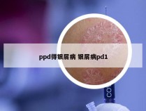 ppd得银屑病 银屑病pd1