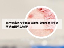 郑州哪家医院看银屑病正规 郑州哪里有看银屑病的医院比较好