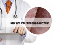 胡椒治牛皮癣 银屑病能不能吃胡椒