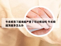 牛皮癣发了越来越严重了可以根治吗 牛皮癣越发越多怎么办