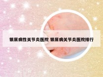 银屑病性关节炎医院 银屑病关节炎医院排行