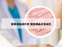 银屑病连成片状 银屑病由点变成片