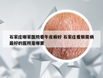 石家庄哪家医院看牛皮癣好 石家庄看银屑病最好的医院是哪里