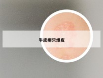 牛皮癣只爆皮