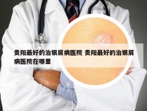 贵阳最好的治银屑病医院 贵阳最好的治银屑病医院在哪里