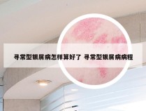 寻常型银屑病怎样算好了 寻常型银屑病病程