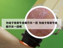 为啥子有些牛皮癣只长一团 为啥子有些牛皮癣只长一团呢