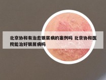 北京协和有治愈银屑病的案例吗 北京协和医院能治好银屑病吗