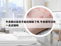 牛皮癣以后也不能吃辣椒了吗 牛皮癣可以吃一点点辣吗