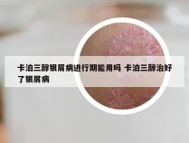 卡泊三醇银屑病进行期能用吗 卡泊三醇治好了银屑病