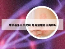醋和皂角治牛皮癣 皂角加醋能治面瘫吗