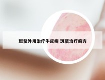 斑蝥外用治疗牛皮癣 斑蝥治疗癣方